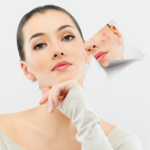 Summer Skincare Routine for Acne Prone Skin